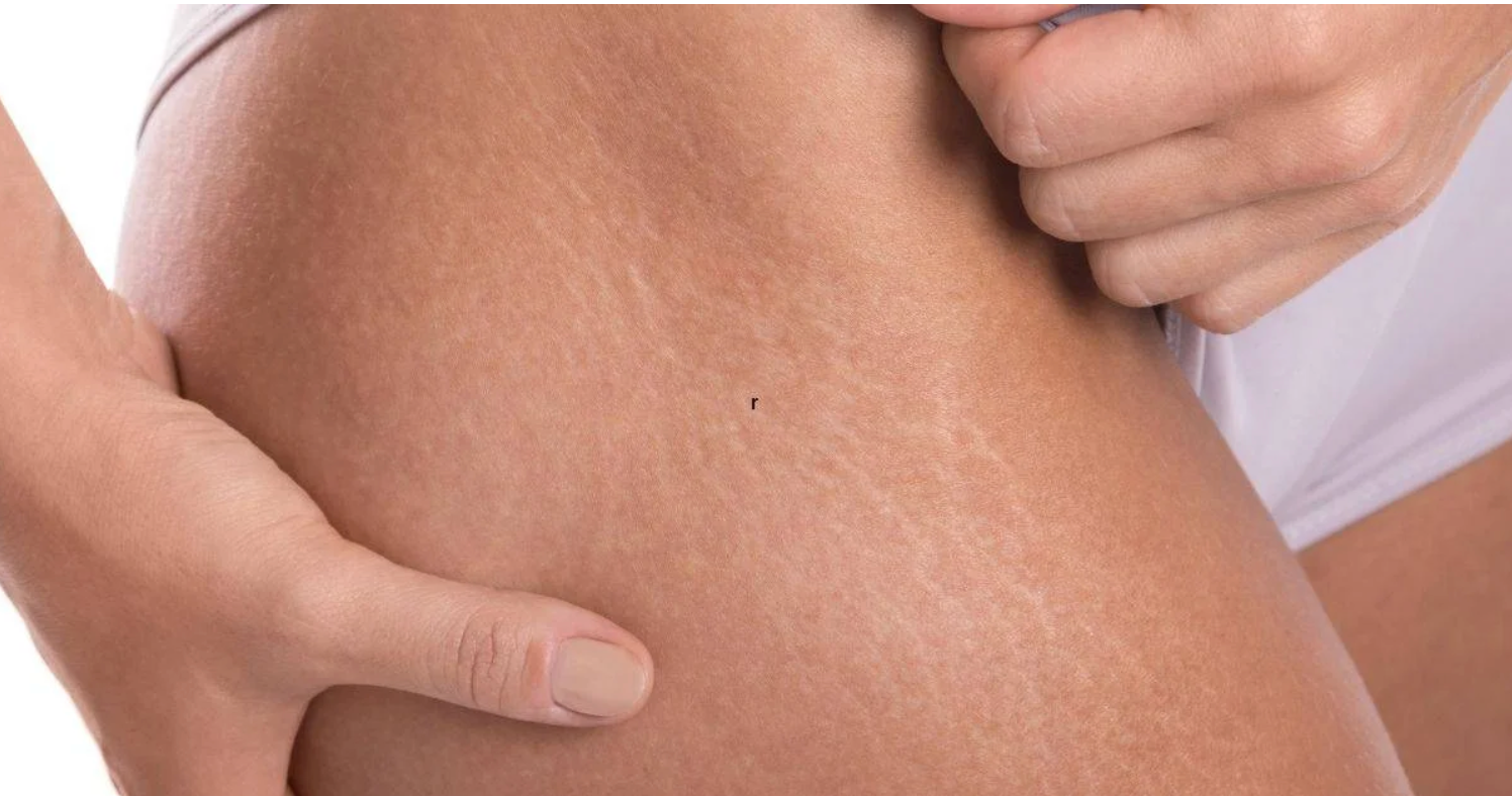 Striae of acne littekens dermarollen