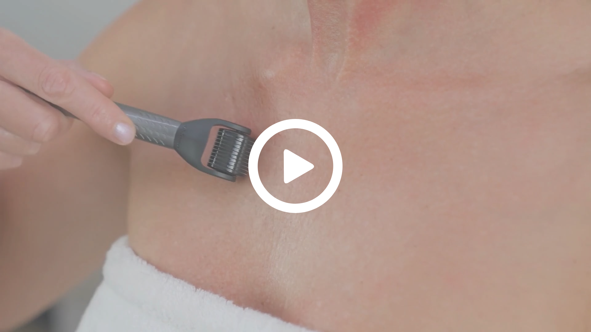 Decolleté rimpels microneedling