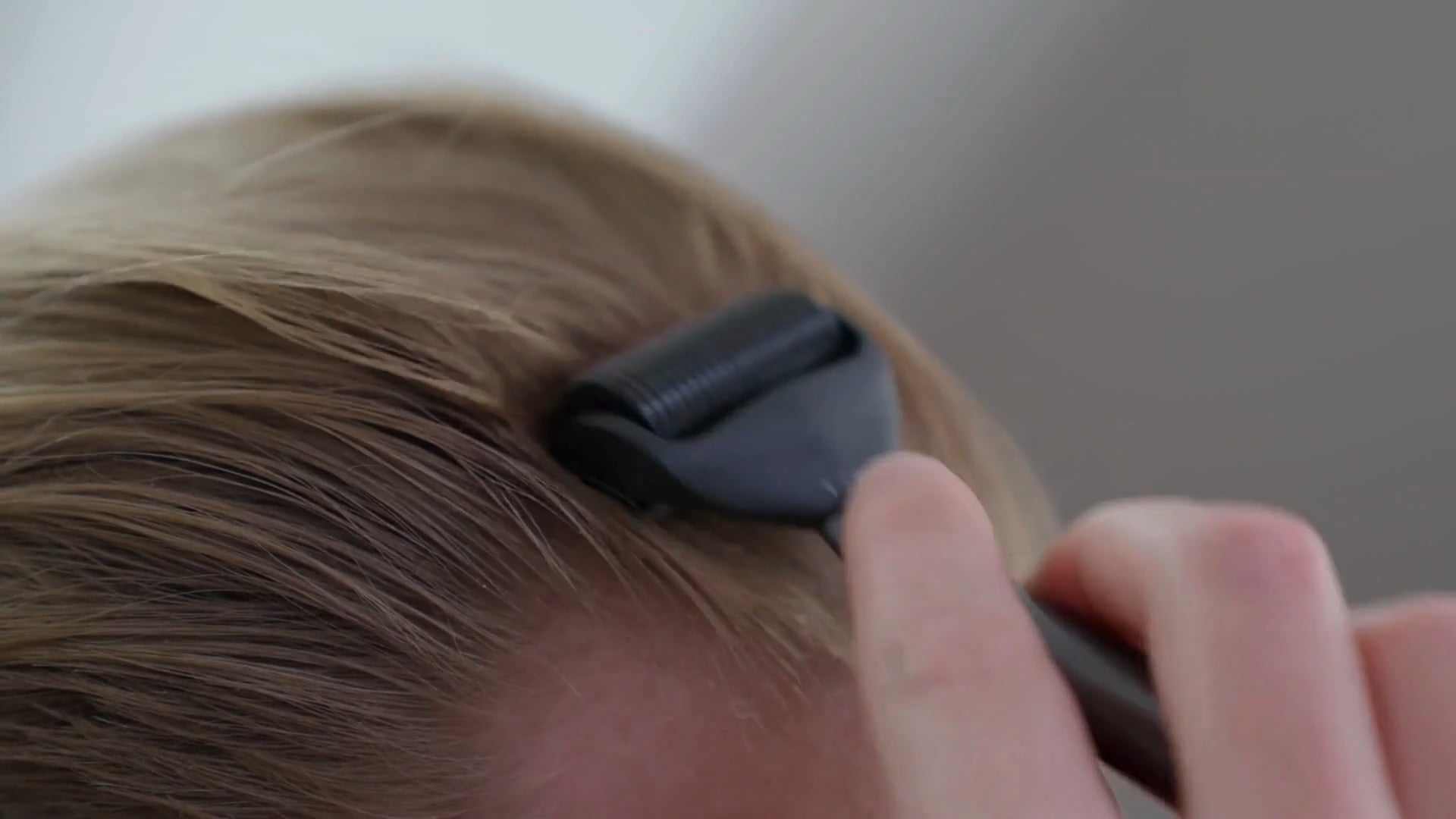 haargroei wordt gestimuleerd met een dermaroller