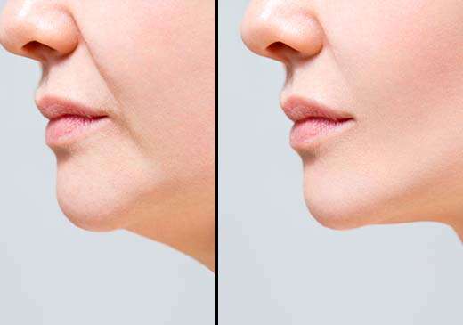 hangende mondhoeken, huidverslapping, verslapte huid, hamsterwangen, jonger uitzien, microneedling, dermarollen, LAYZIN microneedling, LAYZIN dermaroller, Power &n Protect Cream SPF 30, UV-straling, huid beschermen