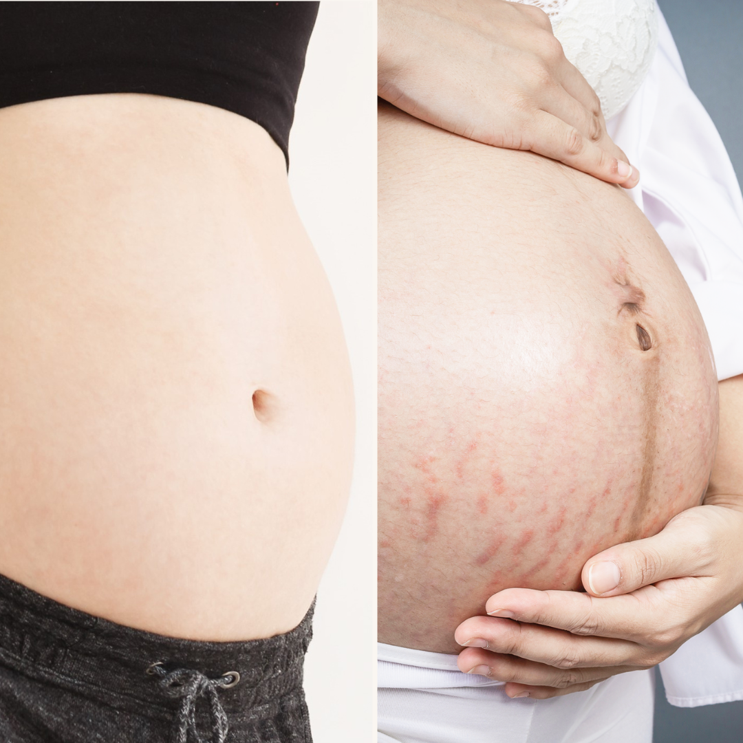 zwangerschap striae en littekens