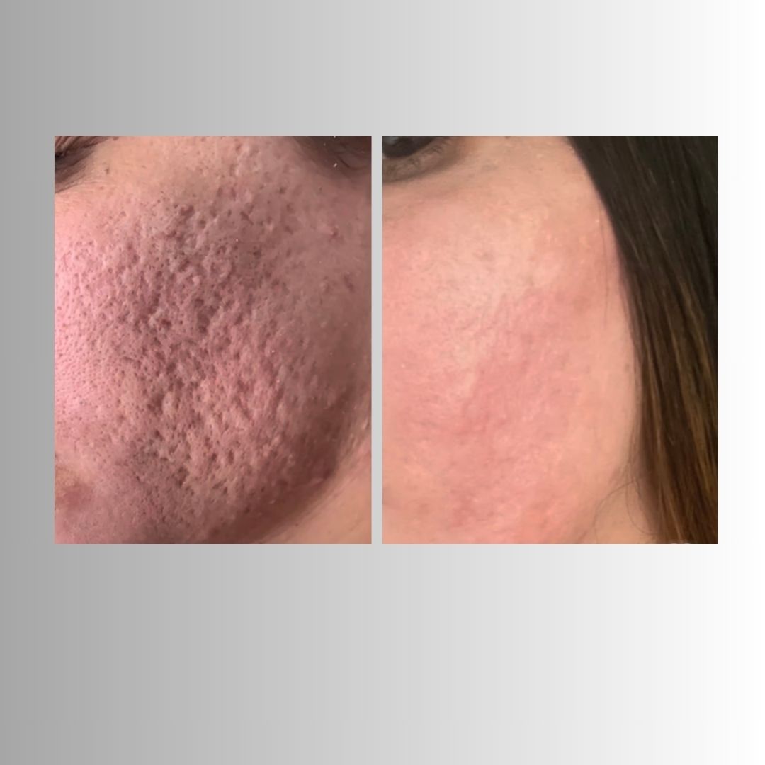 Littekens - Acne littekens & Striae dermarollen